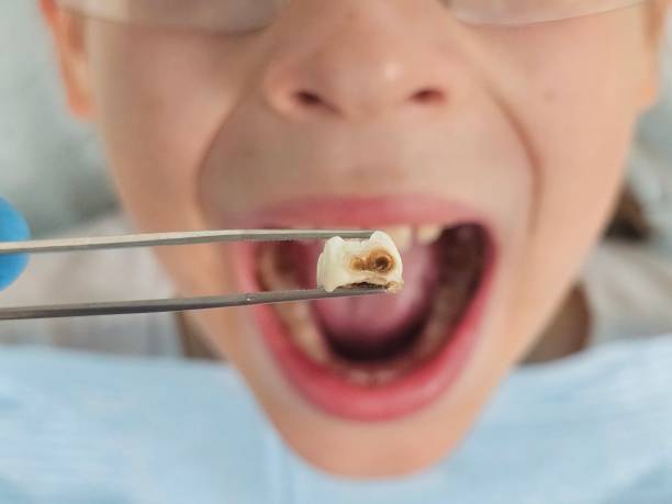 Best Emergency Wisdom Tooth Extraction in Elm Creek, NE